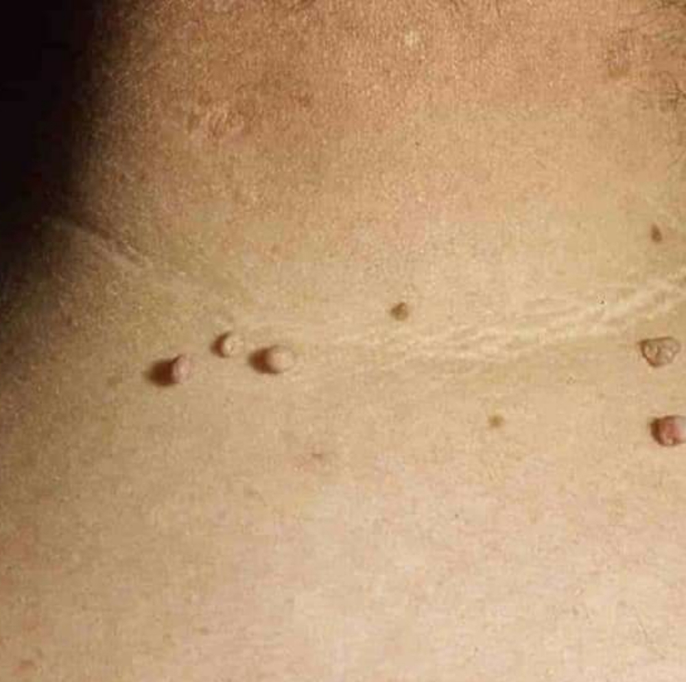 WART REMOVER